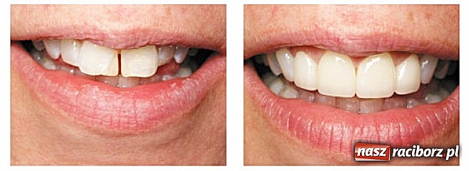 Zdjęcie w galerii na portalu naszraciborz.pl: Licówki porcelanowe – sposób na piękny uśmiech wiadomości z regionu