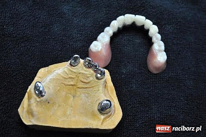 Zdjęcie w galerii na portalu naszraciborz.pl: Protezy teleskopowe – idealne rozwiązanie dla wymagających pacjentów wiadomości z regionu