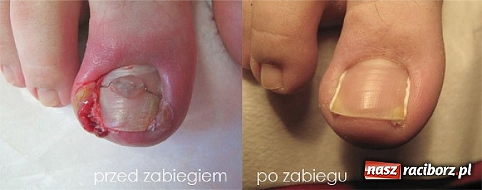 Zdjęcie w galerii na portalu naszraciborz.pl: Bezinwazyjna metoda korekcji wrastania paznokci wiadomości z regionu