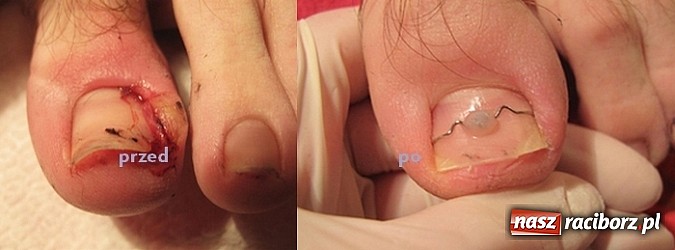 Zdjęcie w galerii na portalu naszraciborz.pl: Bezinwazyjna metoda korekcji wrastania paznokci wiadomości z regionu