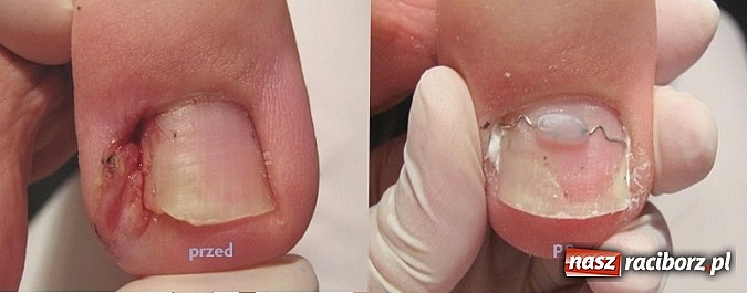 Zdjęcie w galerii na portalu naszraciborz.pl: Bezinwazyjna metoda korekcji wrastania paznokci wiadomości z regionu