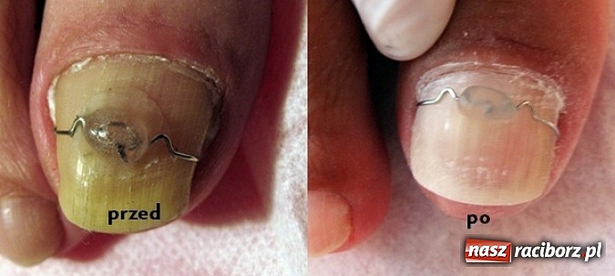 Zdjęcie w galerii na portalu naszraciborz.pl: Bezinwazyjna metoda korekcji wrastania paznokci wiadomości z regionu
