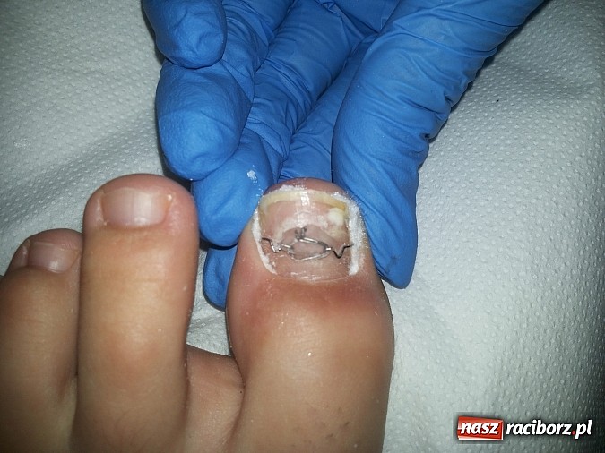 Zdjęcie w galerii na portalu naszraciborz.pl: Bezinwazyjna metoda korekcji wrastania paznokci wiadomości z regionu