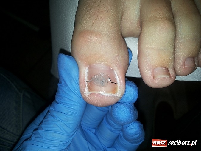 Zdjęcie w galerii na portalu naszraciborz.pl: Bezinwazyjna metoda korekcji wrastania paznokci wiadomości z regionu
