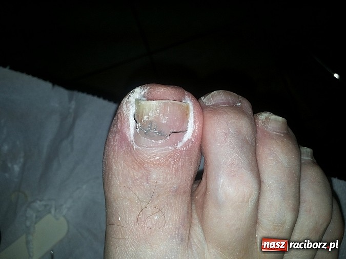 Zdjęcie w galerii na portalu naszraciborz.pl: Bezinwazyjna metoda korekcji wrastania paznokci wiadomości z regionu