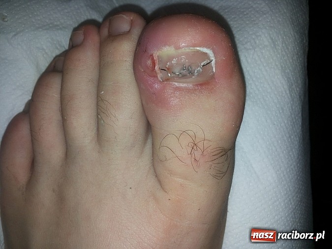 Zdjęcie w galerii na portalu naszraciborz.pl: Bezinwazyjna metoda korekcji wrastania paznokci wiadomości z regionu