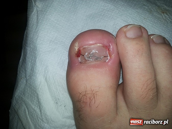 Zdjęcie w galerii na portalu naszraciborz.pl: Bezinwazyjna metoda korekcji wrastania paznokci wiadomości z regionu