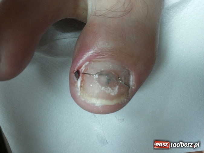 Zdjęcie w galerii na portalu naszraciborz.pl: Bezinwazyjna metoda korekcji wrastania paznokci wiadomości z regionu