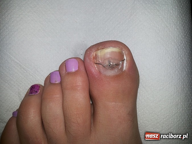Zdjęcie w galerii na portalu naszraciborz.pl: Bezinwazyjna metoda korekcji wrastania paznokci wiadomości z regionu