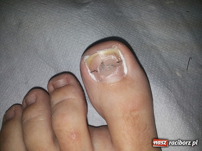 Zdjęcie w galerii na portalu naszraciborz.pl: Bezinwazyjna metoda korekcji wrastania paznokci wiadomości z regionu