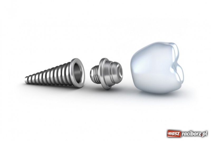 Zdjęcie w galerii na portalu naszraciborz.pl: Czym są implanty zębowe?  wiadomości z regionu