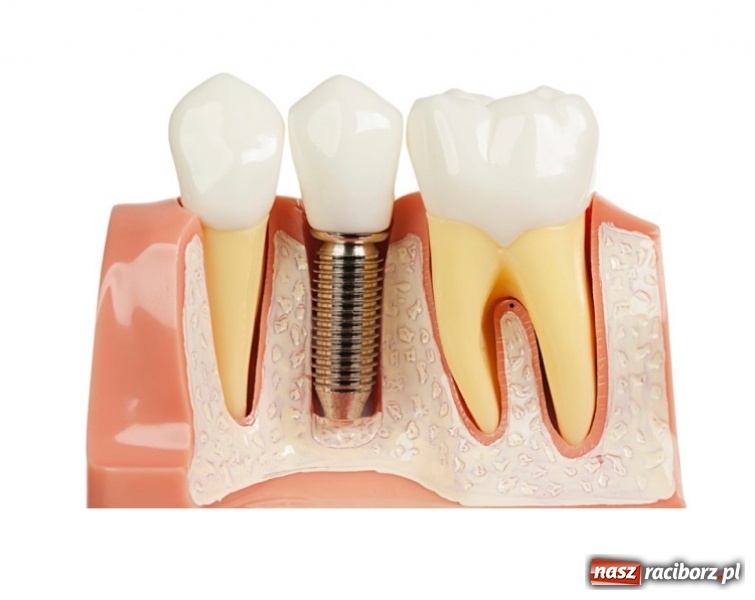 Zdjęcie w galerii na portalu naszraciborz.pl: Czym są implanty zębowe?  wiadomości z regionu