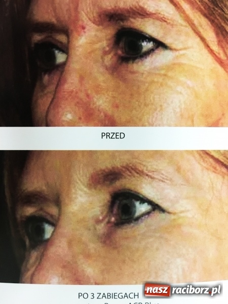 Zdjęcie w galerii na portalu naszraciborz.pl: Wampirzy lifting, czyli terapia osoczem bogatopłykowym wiadomości z regionu