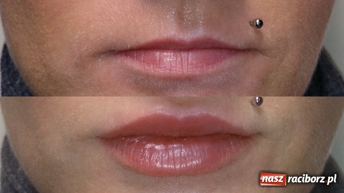 Zdjęcie w galerii na portalu naszraciborz.pl: Metamorfozy - stomatologia i medycyna estetyczna krok po kroku wiadomości z regionu