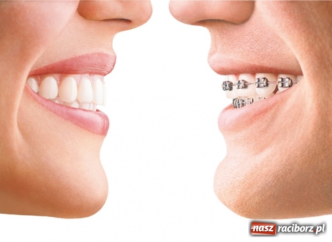 Zdjęcie w galerii na portalu naszraciborz.pl: Niewidoczne aparaty ortodontyczne wiadomości z regionu