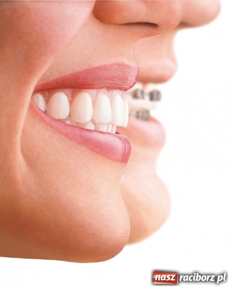 Zdjęcie w galerii na portalu naszraciborz.pl: Niewidoczne aparaty ortodontyczne wiadomości z regionu