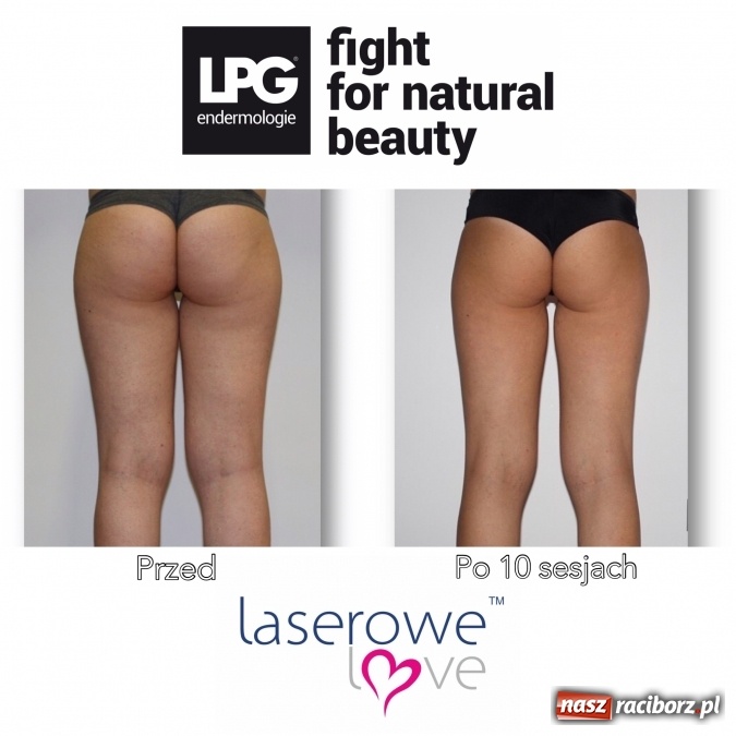 Zdjęcie w galerii na portalu naszraciborz.pl: Laserowe Love – z miłości do piękna i laserowych zabiegów wiadomości z regionu