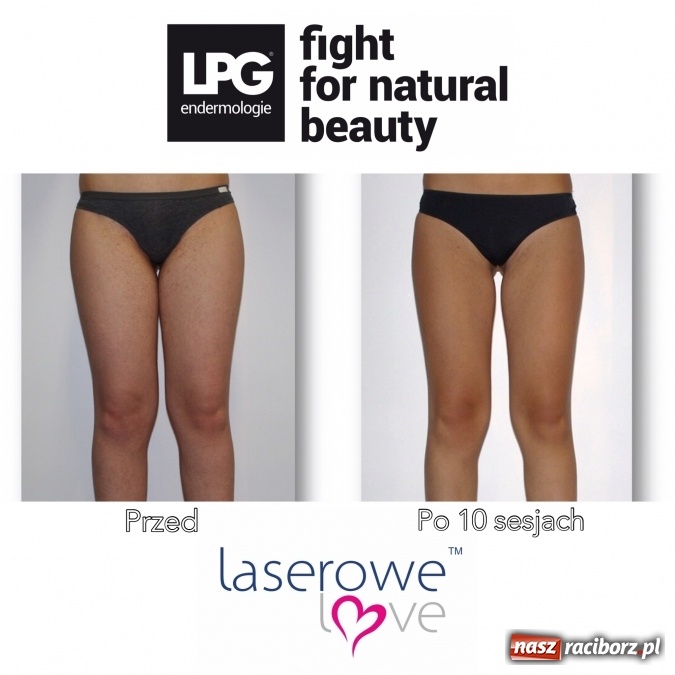 Zdjęcie w galerii na portalu naszraciborz.pl: Laserowe Love – z miłości do piękna i laserowych zabiegów wiadomości z regionu