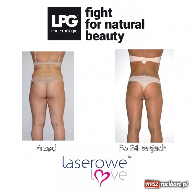 Zdjęcie w galerii na portalu naszraciborz.pl: Laserowe Love – z miłości do piękna i laserowych zabiegów wiadomości z regionu