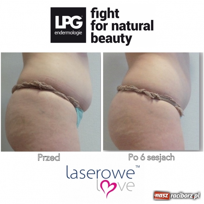 Zdjęcie w galerii na portalu naszraciborz.pl: Laserowe Love – z miłości do piękna i laserowych zabiegów wiadomości z regionu