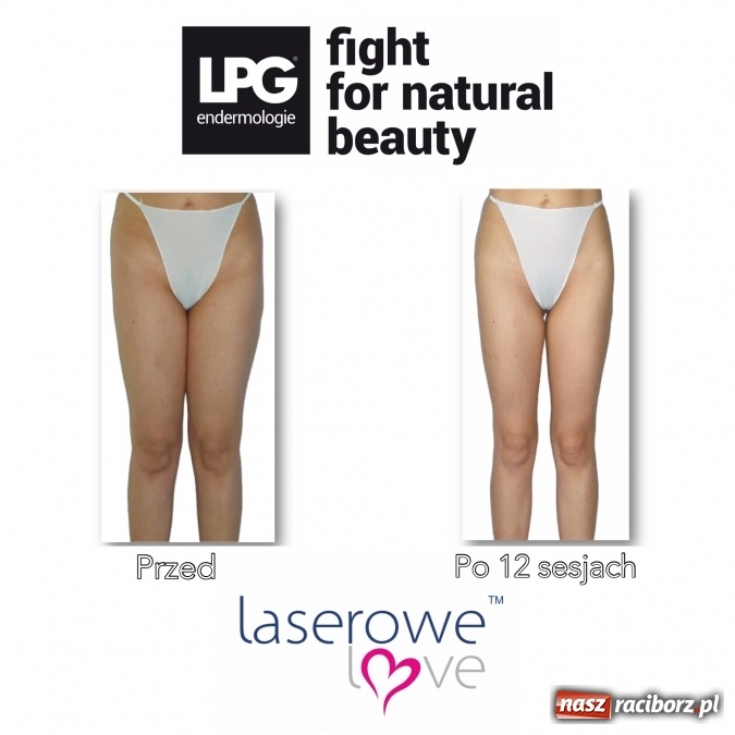 Zdjęcie w galerii na portalu naszraciborz.pl: Laserowe Love – z miłości do piękna i laserowych zabiegów wiadomości z regionu