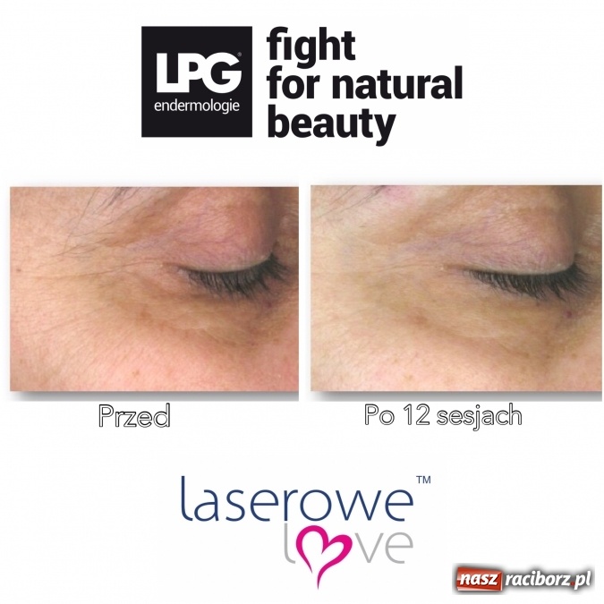 Zdjęcie w galerii na portalu naszraciborz.pl: Laserowe Love – z miłości do piękna i laserowych zabiegów wiadomości z regionu