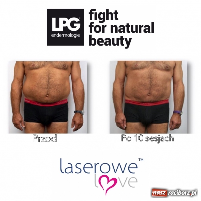 Zdjęcie w galerii na portalu naszraciborz.pl: Laserowe Love – z miłości do piękna i laserowych zabiegów wiadomości z regionu