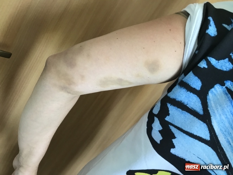 Zdjęcie w galerii na portalu naszraciborz.pl: 36-latka z Owsiszcz oskarża raciborskich policjantów o pobicie  wiadomości z regionu