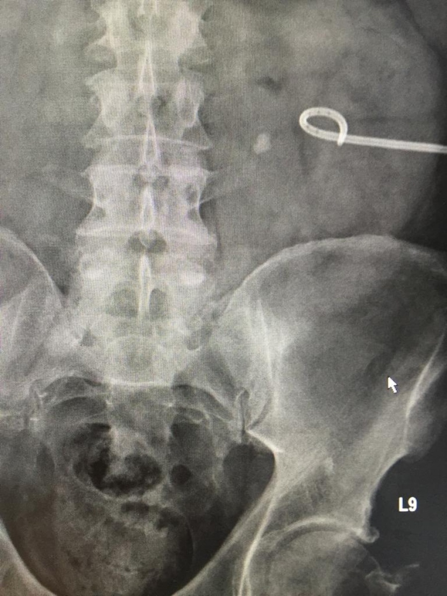 Zdjęcie w galerii na portalu naszraciborz.pl: Nowatorska operacja kamicy moczowej w szpitalu w Kędzierzynie-Koźlu wiadomości z regionu