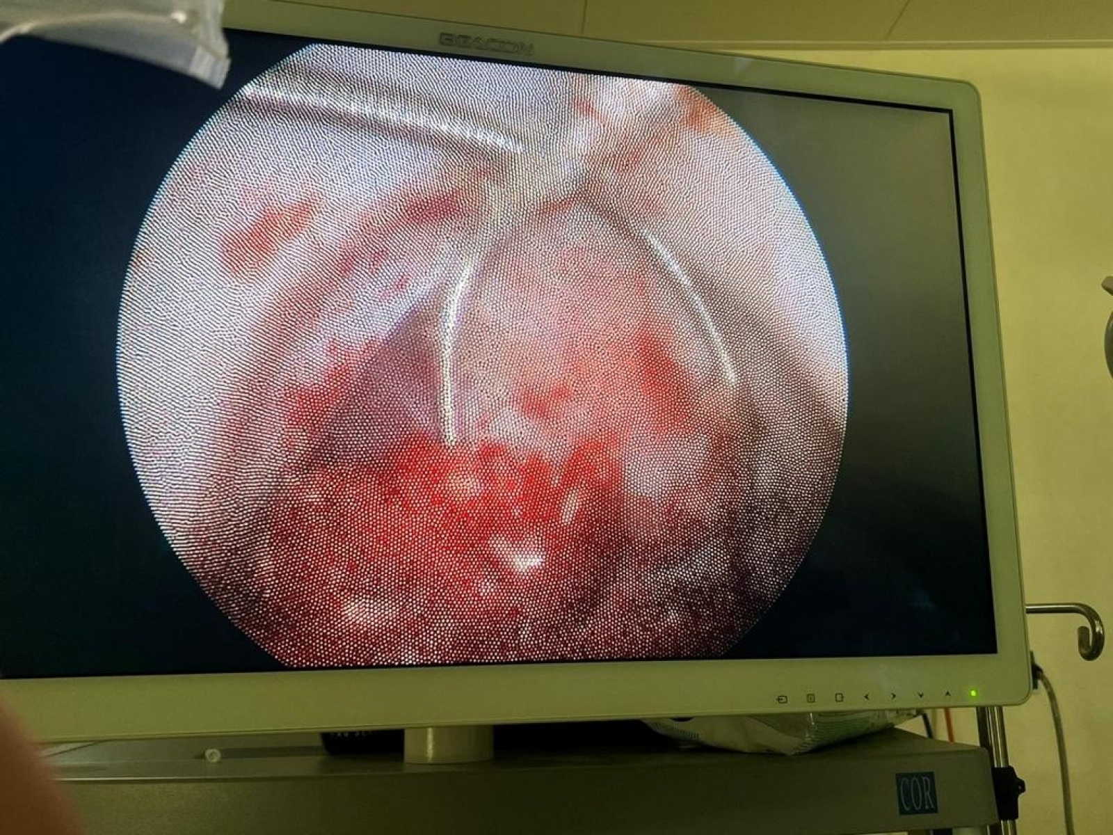 Zdjęcie w galerii na portalu naszraciborz.pl: Nowatorska operacja kamicy moczowej w szpitalu w Kędzierzynie-Koźlu wiadomości z regionu