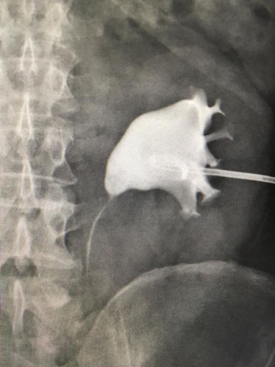 Zdjęcie w galerii na portalu naszraciborz.pl: Nowatorska operacja kamicy moczowej w szpitalu w Kędzierzynie-Koźlu wiadomości z regionu