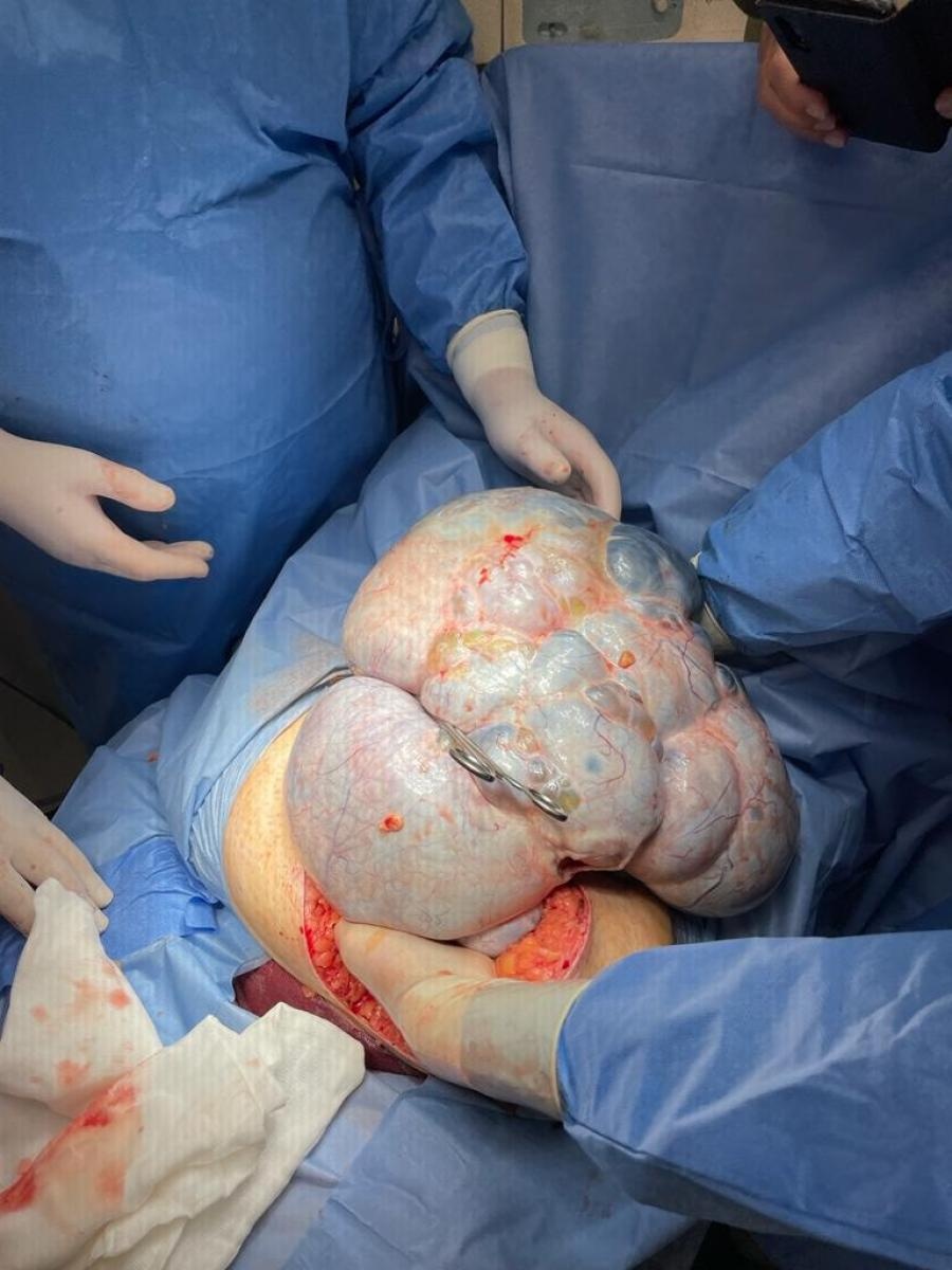 Zdjęcie w galerii na portalu naszraciborz.pl: W szpitalu w Kędzierzynie-Koźlu usunięto pacjentce jedenastokilogramowy guz jajnika [FOTO] wiadomości z regionu