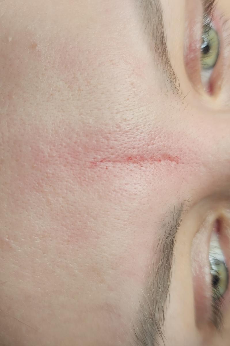 Zdjęcie w galerii na portalu naszraciborz.pl: Specjalistyczne terapie blizn w DW. Studio Urody Dominika Wallach, Racibórz ul. Kozielska 24A wiadomości z regionu