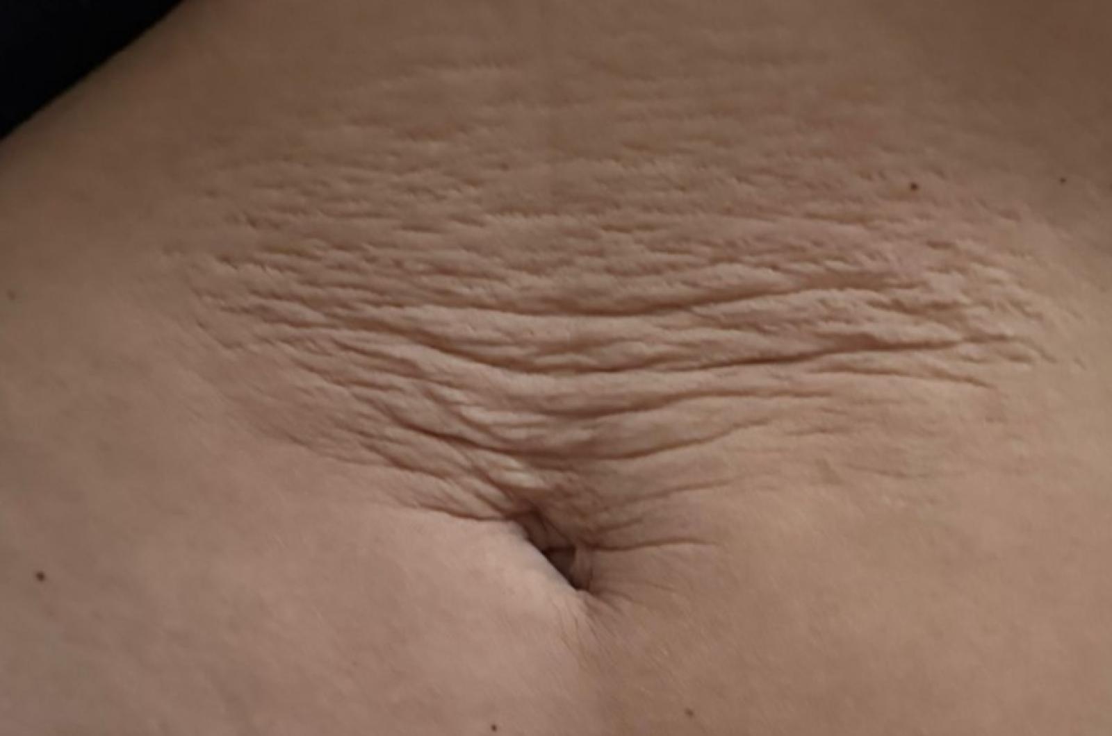 Zdjęcie w galerii na portalu naszraciborz.pl: Specjalistyczne terapie blizn w DW. Studio Urody Dominika Wallach, Racibórz ul. Kozielska 24A wiadomości z regionu