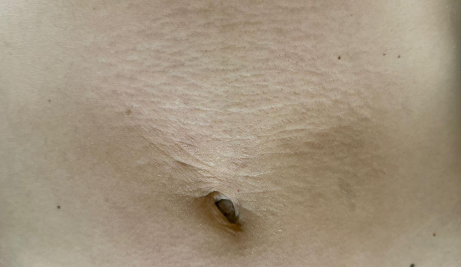 Zdjęcie w galerii na portalu naszraciborz.pl: Specjalistyczne terapie blizn w DW. Studio Urody Dominika Wallach, Racibórz ul. Kozielska 24A wiadomości z regionu