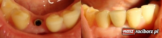 Zdjęcie w galerii na portalu naszraciborz.pl: Brak zęba boli! wiadomości z regionu