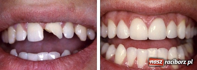 Zdjęcie w galerii na portalu naszraciborz.pl: Architekci pięknego uśmiechu wiadomości z regionu