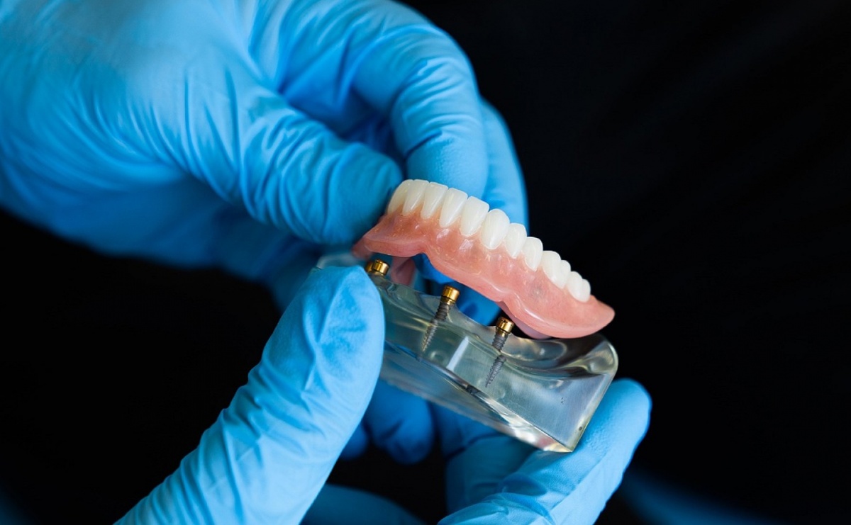 Implanty a protezy zębowe — co wybrać? - Serwis informacyjny z Raciborza - naszraciborz.pl