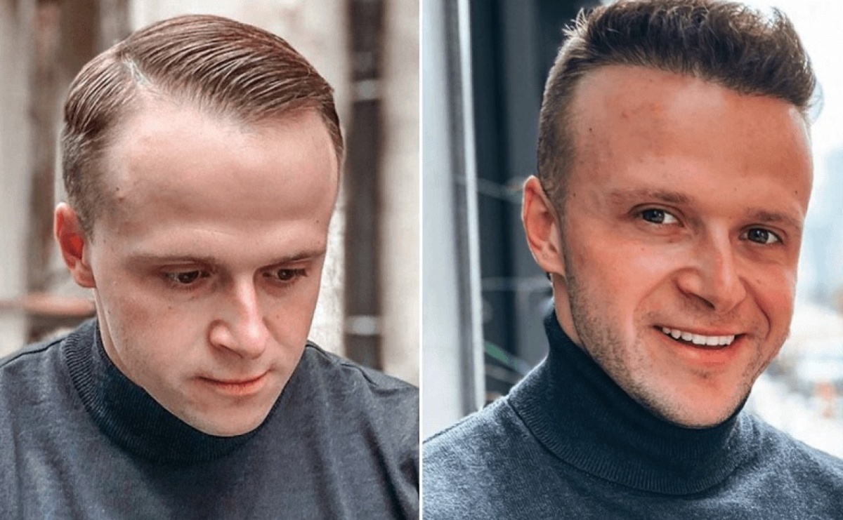 Najczęściej zadawane pytania: Przeszczep włosów w Turcji z Flymedica - Serwis informacyjny z Raciborza - naszraciborz.pl