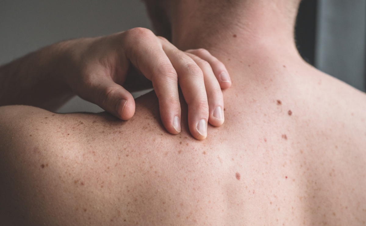 Praktyczne porady jak walczyć z łuszczycą - Serwis informacyjny z Raciborza - naszraciborz.pl