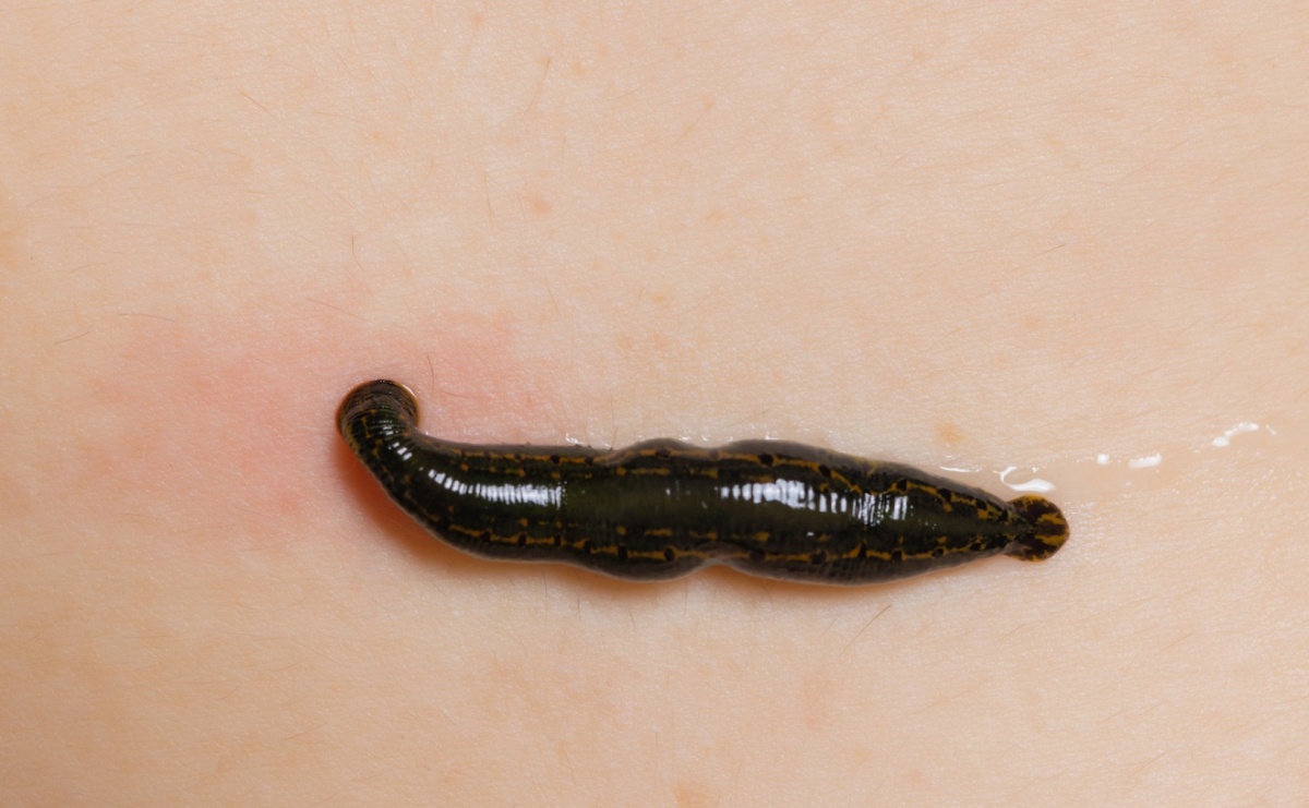 Jakie korzyści może przynieść hirudoterapia w leczeniu trądziku pospolitego? - Serwis informacyjny z Raciborza - naszraciborz.pl