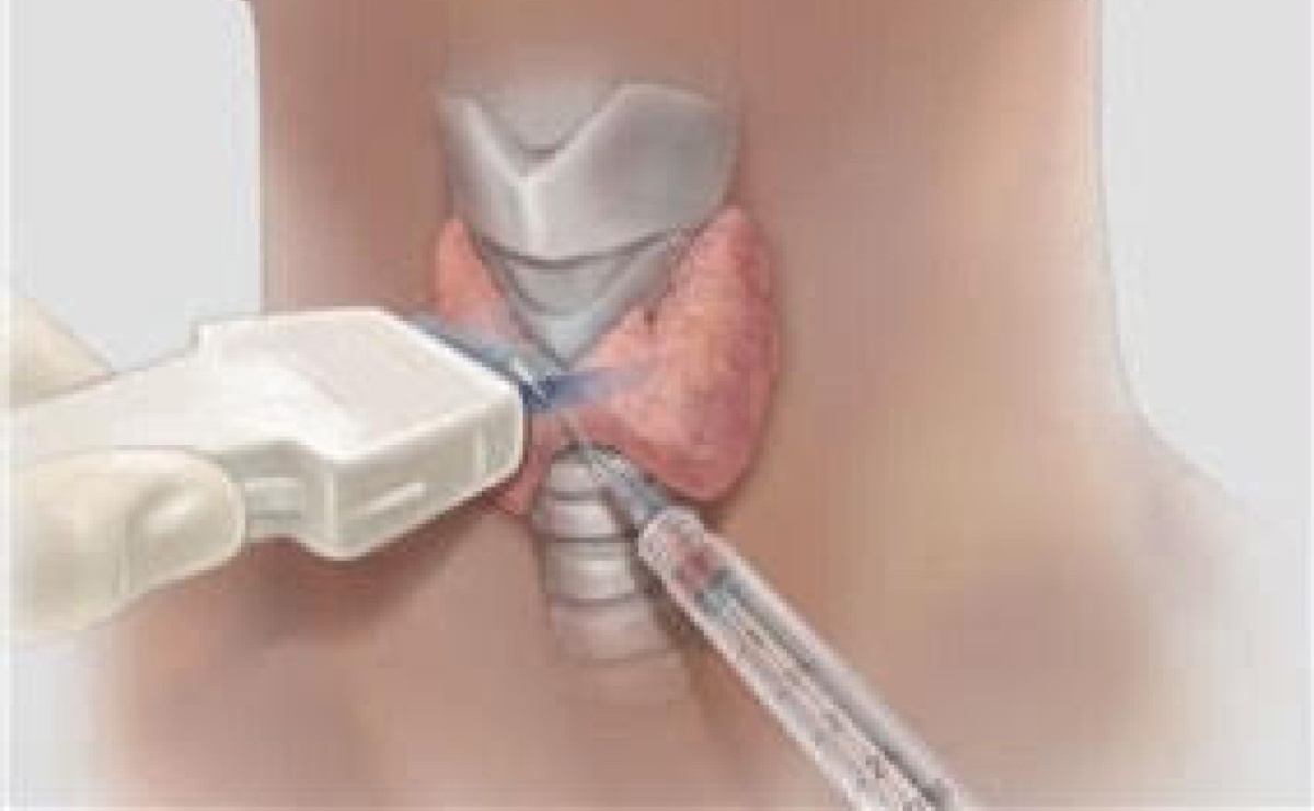 BemaMed Racibórz. Biopsja cienkoigłowa tarczycy - BACC - Serwis informacyjny z Raciborza - naszraciborz.pl