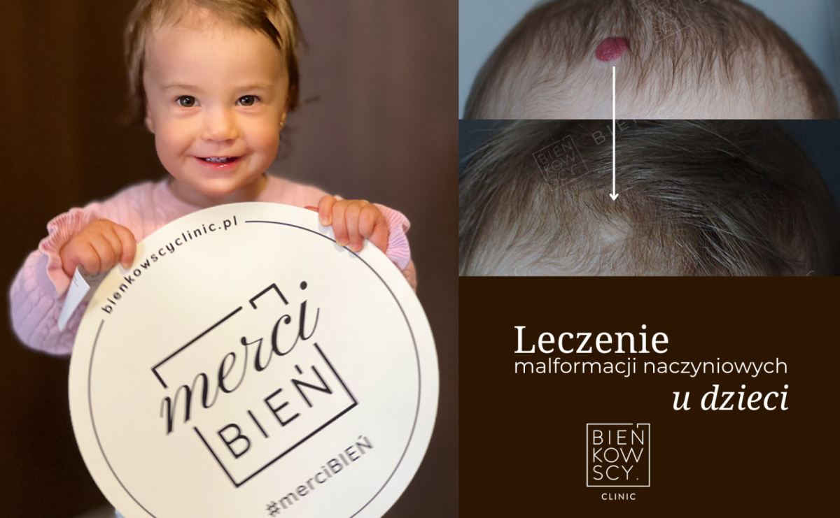 leczenie-malformacji-naczyniowych-dzieci-bienkowscyclinic
