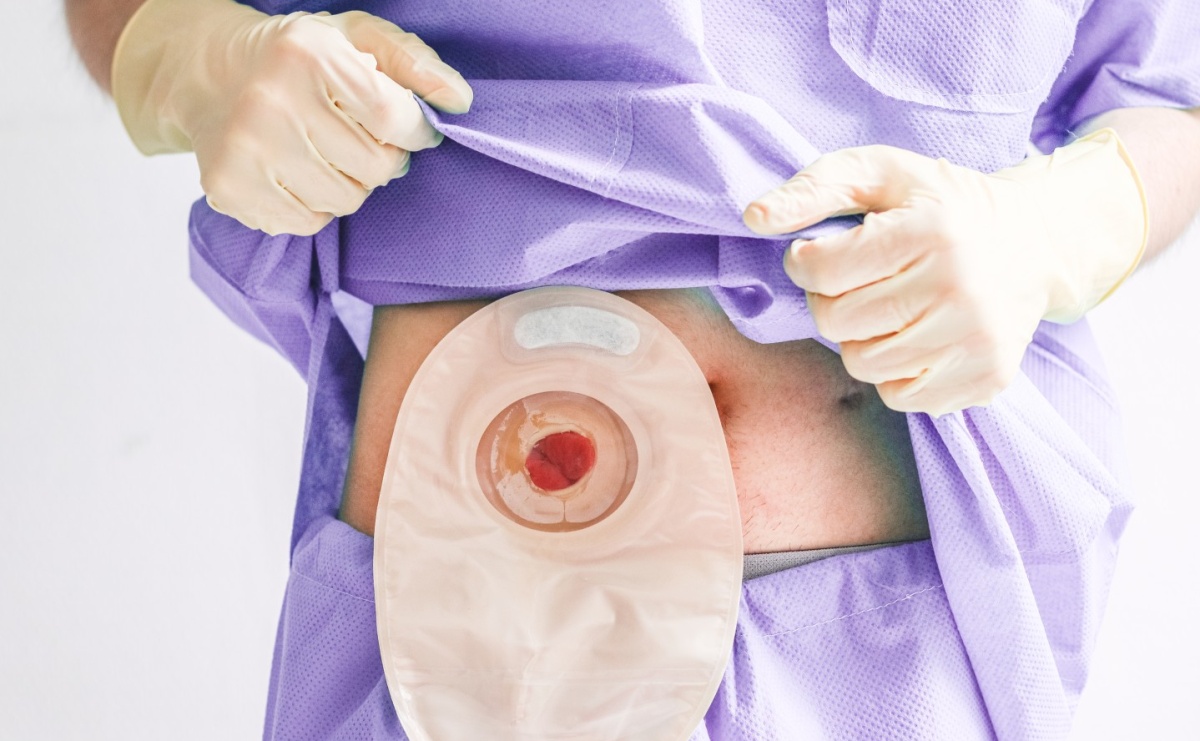 Worki stomijne - rodzaje, zastosowanie i sposób użycia - Serwis informacyjny z Raciborza - naszraciborz.pl